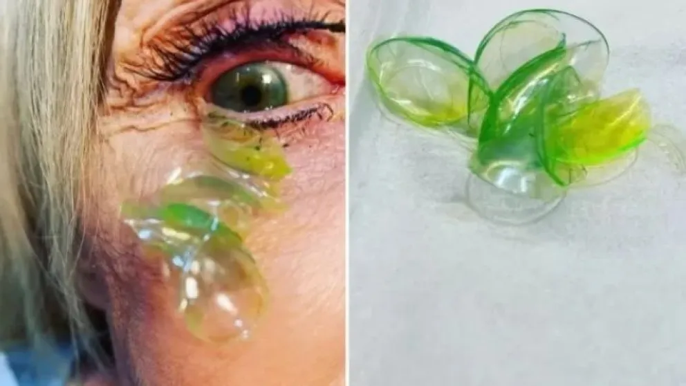 Remueven 23 lentes de contacto a una mujer que los tenía acumulados en sus ojos
